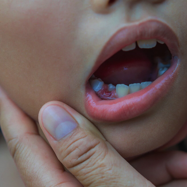 root canal for kids