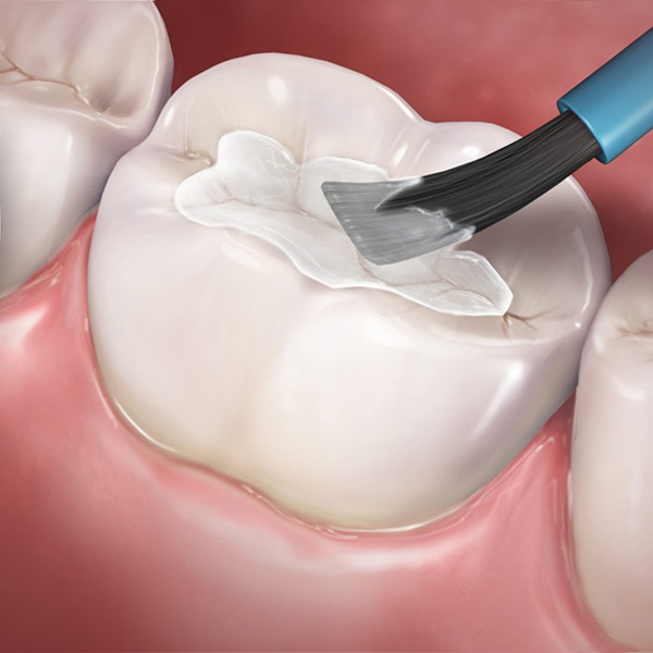 sealants