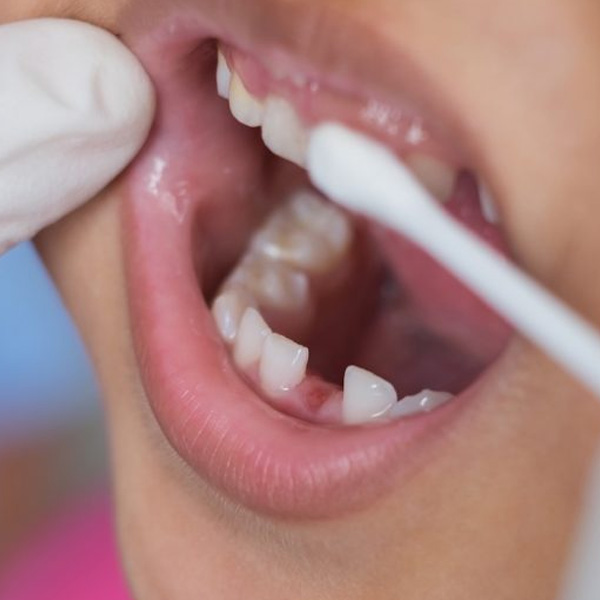 placing fluoride