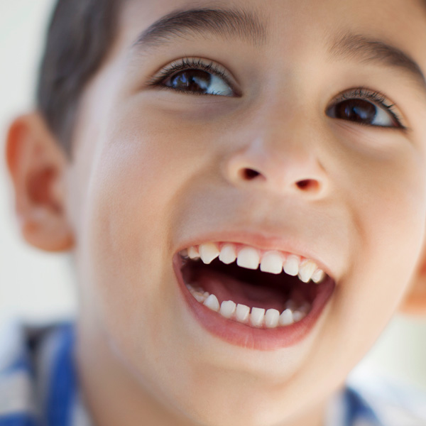 fluoride varnish